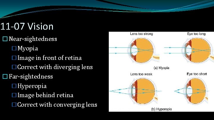 11 -07 Vision �Near-sightedness �Myopia �Image in front of retina �Correct with diverging lens