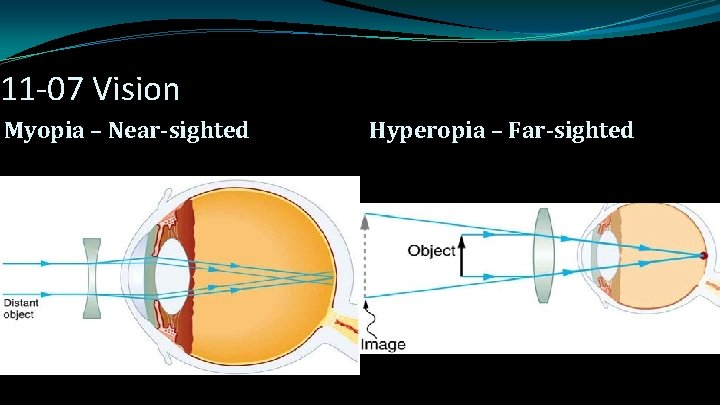 11 -07 Vision Myopia – Near-sighted Hyperopia – Far-sighted 