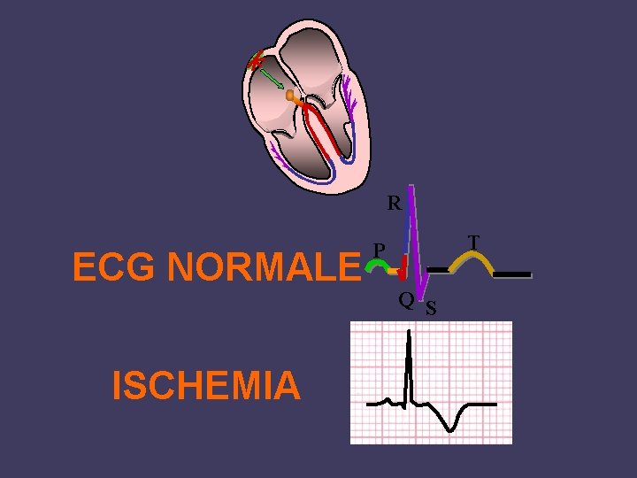 R ECG NORMALE ISCHEMIA T P Q S 