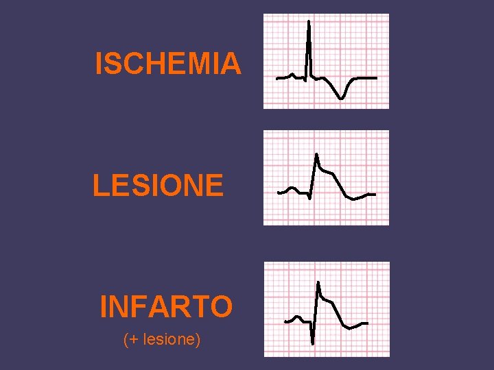 ISCHEMIA LESIONE INFARTO (+ lesione) 