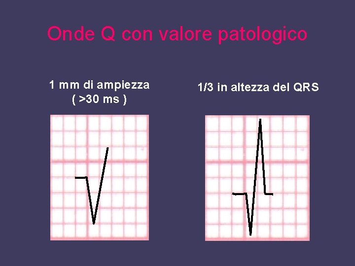 Onde Q con valore patologico 1 mm di ampiezza ( >30 ms ) 1/3