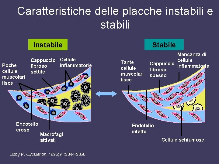 Caratteristiche delle placche instabili e stabili Instabile Poche cellule muscolari lisce Cappuccio Cellule infiammatorie