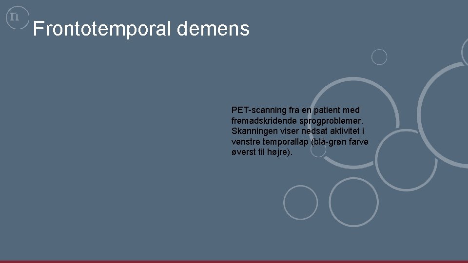 Frontotemporal demens PET-scanning fra en patient med fremadskridende sprogproblemer. Skanningen viser nedsat aktivitet i