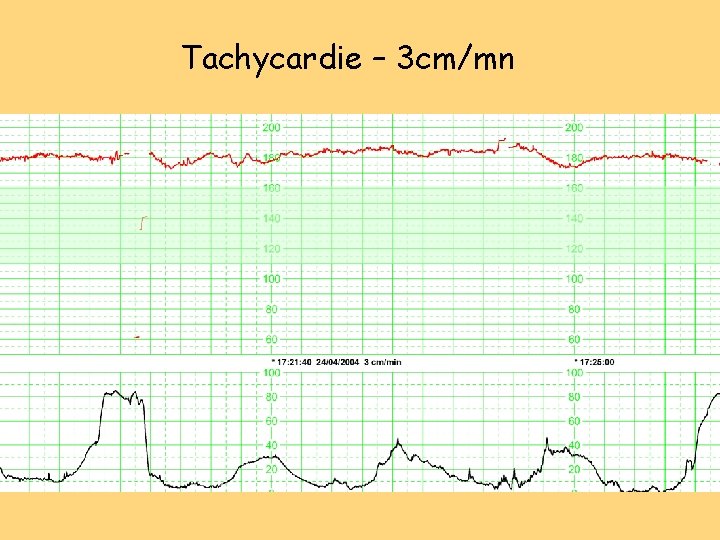 Tachycardie – 3 cm/mn Tachycardie – 3 cm/mn