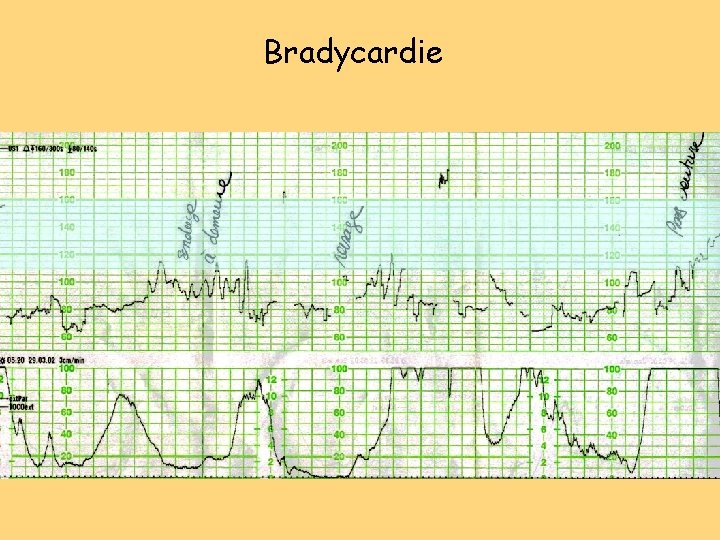 Bradycardie Bradycardie