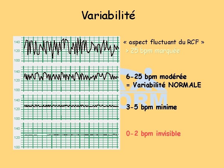 Variabilité 140 120 « aspect fluctuant du RCF » > 25 bpm marquée 100 Variabilité 140 120 « aspect fluctuant du RCF » > 25 bpm marquée 100