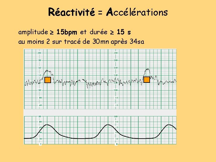 Réactivité = Accélérations amplitude 15 bpm et durée 15 s au moins 2 sur Réactivité = Accélérations amplitude 15 bpm et durée 15 s au moins 2 sur
