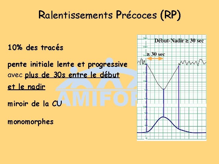Ralentissements Précoces (RP) 10% des tracés pente initiale lente et progressive avec plus de Ralentissements Précoces (RP) 10% des tracés pente initiale lente et progressive avec plus de