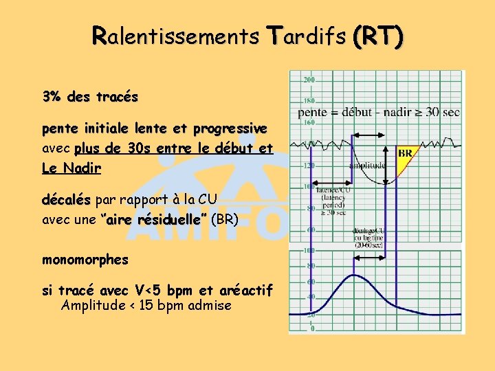 Ralentissements Tardifs (RT) 3% des tracés pente initiale lente et progressive avec plus de Ralentissements Tardifs (RT) 3% des tracés pente initiale lente et progressive avec plus de
