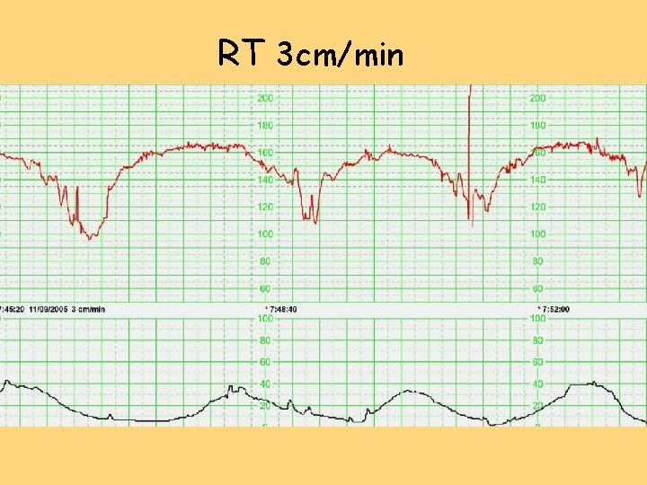 RT 3 cm/min RT 3 cm/min