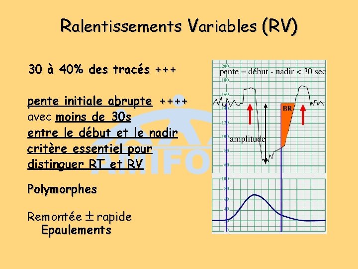 Ralentissements Variables (RV) 30 à 40% des tracés +++ pente initiale abrupte ++++ avec Ralentissements Variables (RV) 30 à 40% des tracés +++ pente initiale abrupte ++++ avec