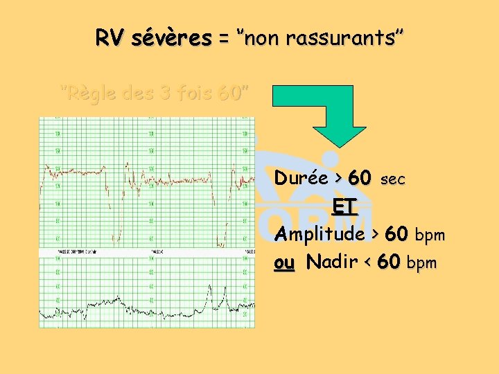 RV sévères = ‘’non rassurants’’ ‘’Règle des 3 fois 60’’ Durée > 60 sec RV sévères = ‘’non rassurants’’ ‘’Règle des 3 fois 60’’ Durée > 60 sec