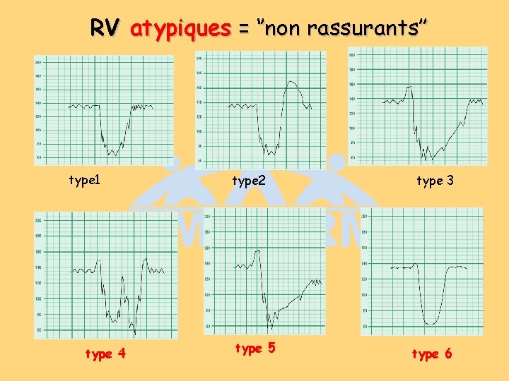 RV atypiques = ‘’non rassurants’’ type 1 type 4 type 2 type 5 type RV atypiques = ‘’non rassurants’’ type 1 type 4 type 2 type 5 type