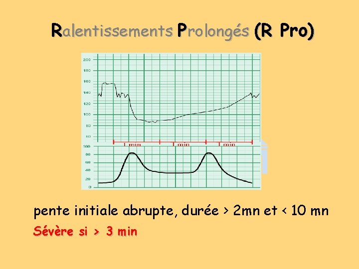 Ralentissements Prolongés (R Pro) pente initiale abrupte, durée > 2 mn et < 10 Ralentissements Prolongés (R Pro) pente initiale abrupte, durée > 2 mn et < 10