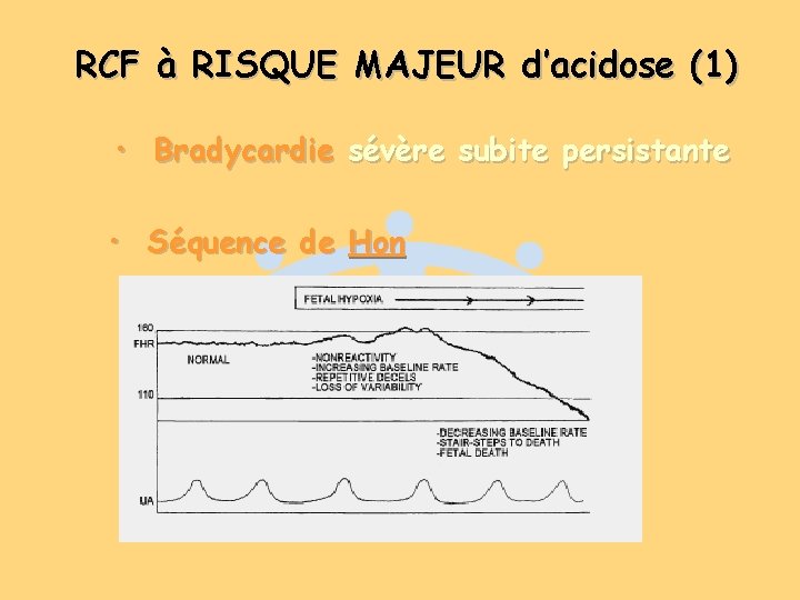 RCF à RISQUE MAJEUR d’acidose (1) • Bradycardie sévère subite persistante • Séquence de RCF à RISQUE MAJEUR d’acidose (1) • Bradycardie sévère subite persistante • Séquence de