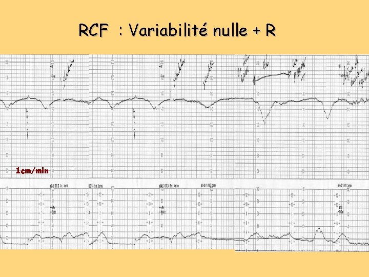 RCF : Variabilité nulle + R 1 cm/min RCF : Variabilité nulle + R 1 cm/min