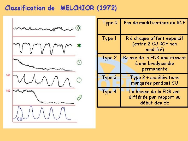 Classification de MELCHIOR (1972) Type 0 Pas de modifications du RCF Type 1 R Classification de MELCHIOR (1972) Type 0 Pas de modifications du RCF Type 1 R