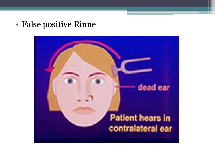  • False positive Rinne 