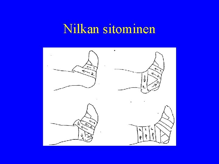 Nilkan sitominen 