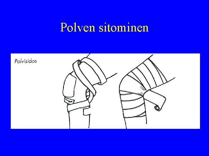 Polven sitominen 