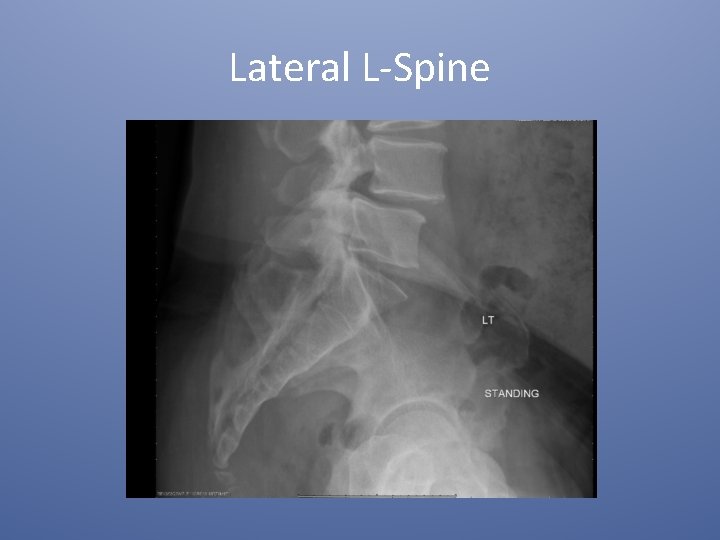 Lateral L-Spine 