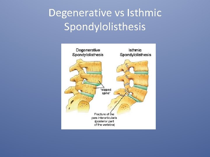 Degenerative vs Isthmic Spondylolisthesis 