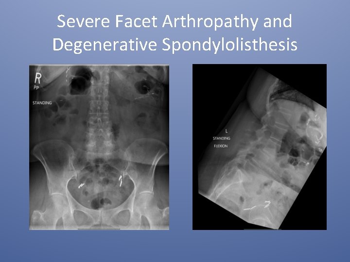 Severe Facet Arthropathy and Degenerative Spondylolisthesis 