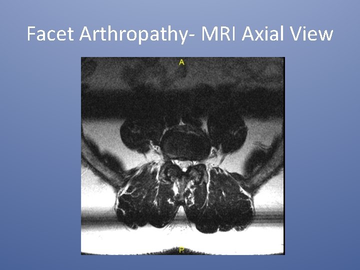 Facet Arthropathy- MRI Axial View 