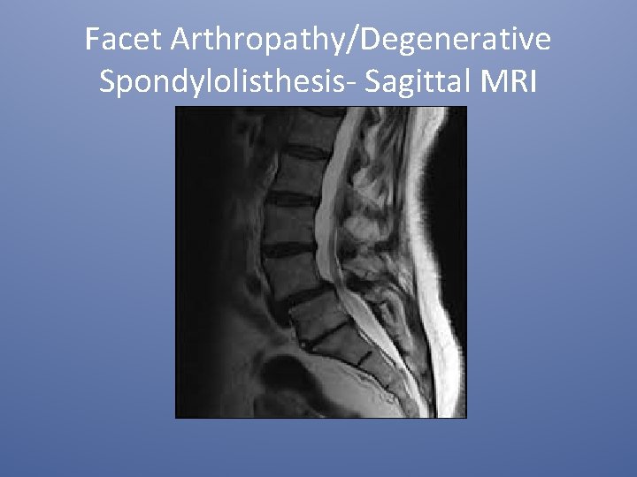 Facet Arthropathy/Degenerative Spondylolisthesis- Sagittal MRI 