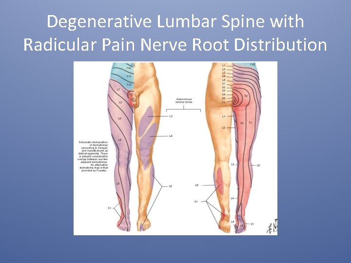 Degenerative Lumbar Spine with Radicular Pain Nerve Root Distribution 