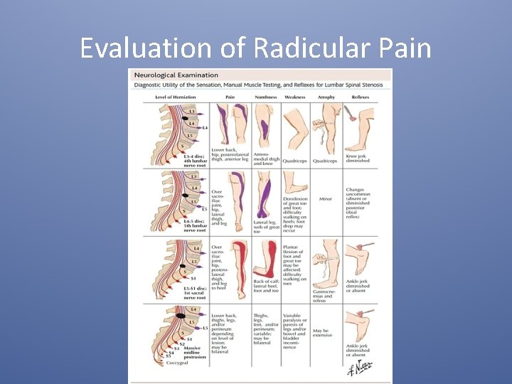 Evaluation of Radicular Pain 