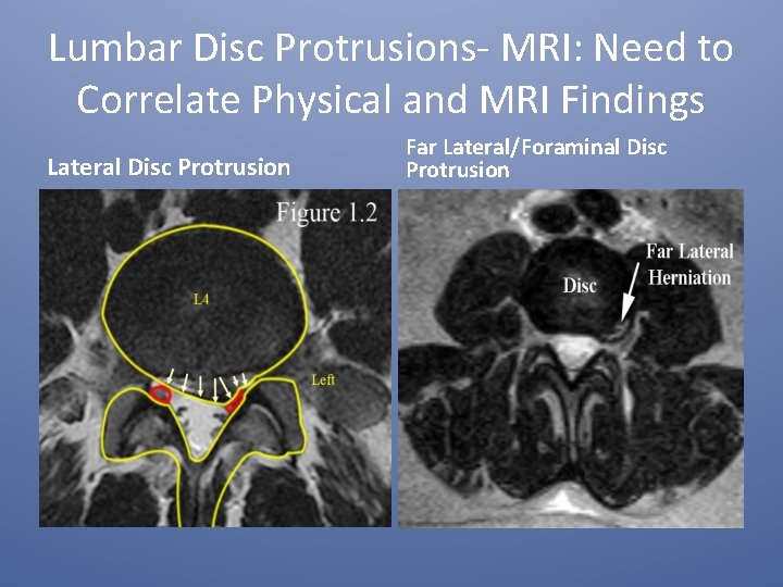 Lumbar Disc Protrusions- MRI: Need to Correlate Physical and MRI Findings Lateral Disc Protrusion