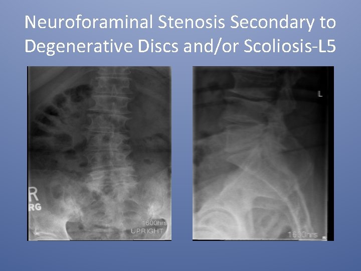 Neuroforaminal Stenosis Secondary to Degenerative Discs and/or Scoliosis-L 5 