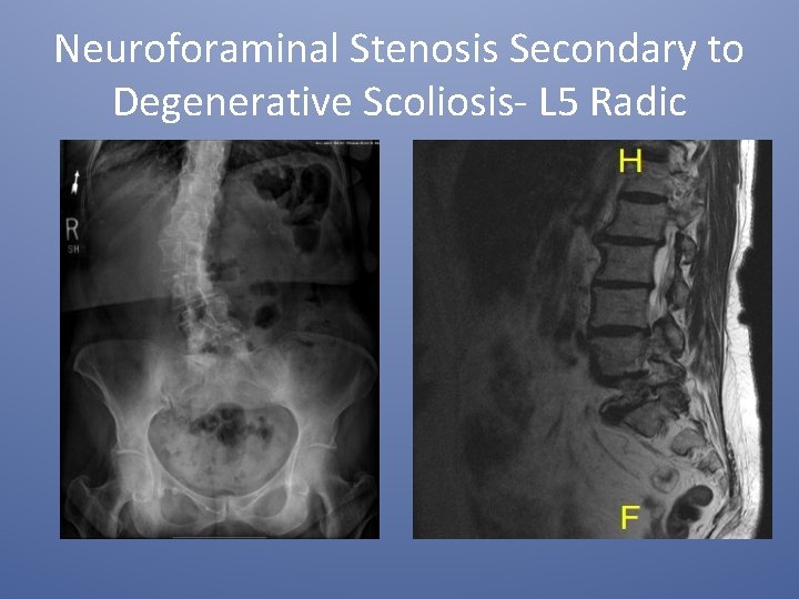 Neuroforaminal Stenosis Secondary to Degenerative Scoliosis- L 5 Radic 
