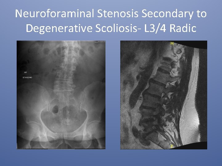 Neuroforaminal Stenosis Secondary to Degenerative Scoliosis- L 3/4 Radic 