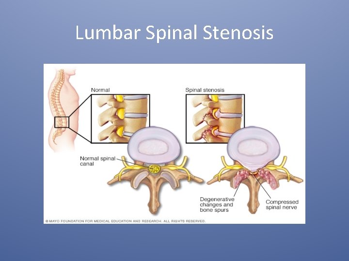 Lumbar Spinal Stenosis 