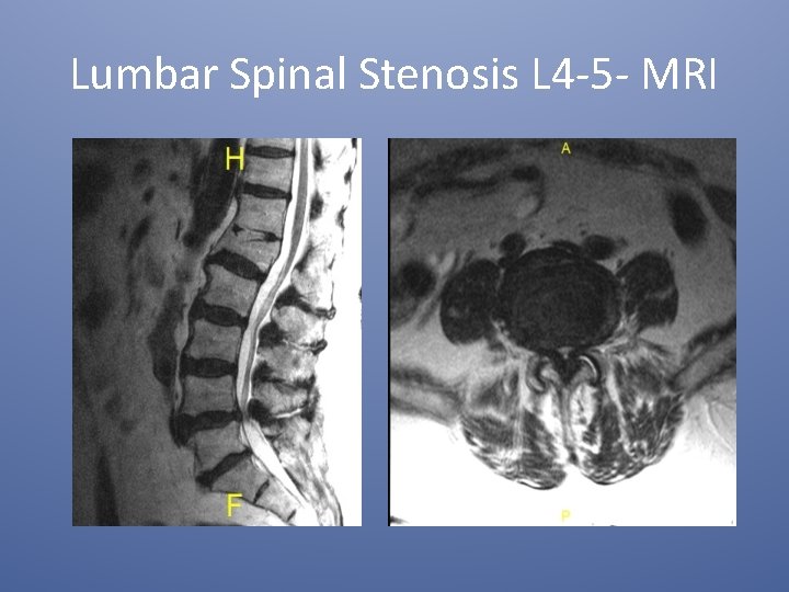 Lumbar Spinal Stenosis L 4 -5 - MRI 