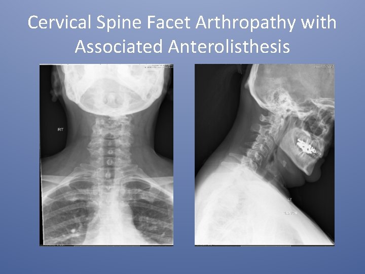 Cervical Spine Facet Arthropathy with Associated Anterolisthesis 