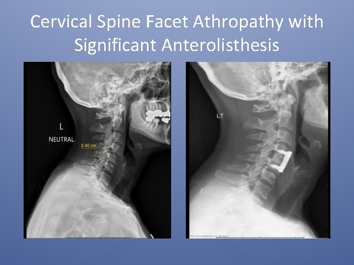 Cervical Spine Facet Athropathy with Significant Anterolisthesis 