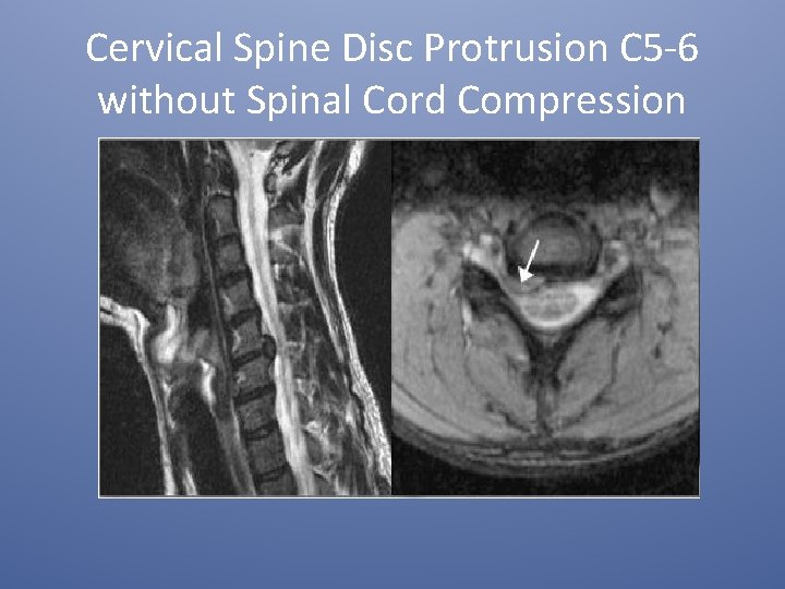 Cervical Spine Disc Protrusion C 5 -6 without Spinal Cord Compression 