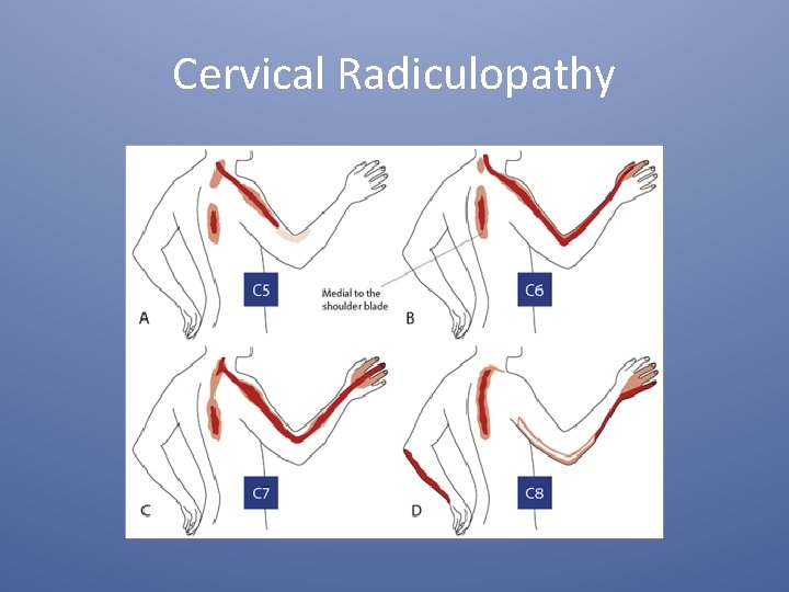 Cervical Radiculopathy 