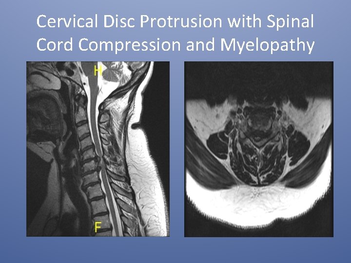 Cervical Disc Protrusion with Spinal Cord Compression and Myelopathy 