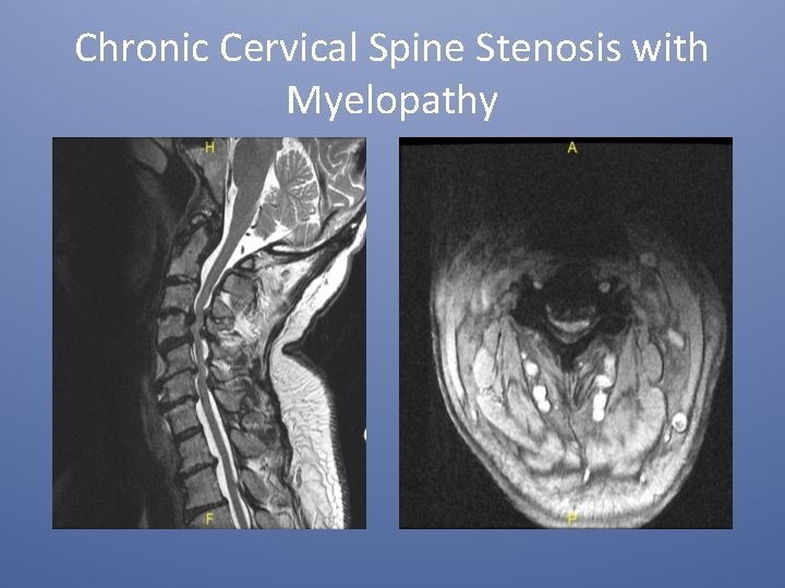 Chronic Cervical Spine Stenosis with Myelopathy 