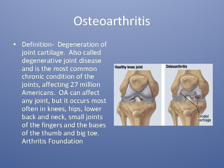 Osteoarthritis • Definition- Degeneration of joint cartilage. Also called degenerative joint disease and is