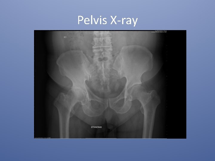 Pelvis X-ray 