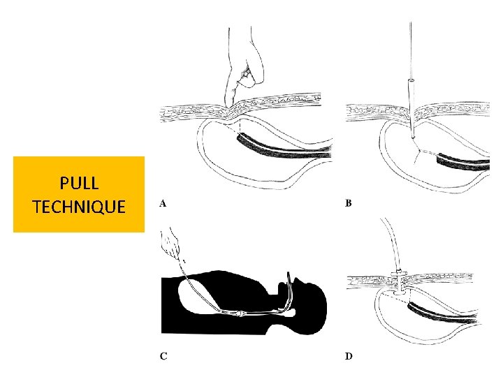 PULL TECHNIQUE PULL TECHNIQUE