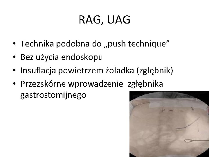 RAG, UAG • • Technika podobna do „push technique” Bez użycia endoskopu Insuflacja powietrzem