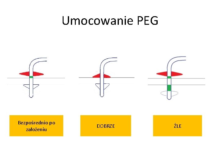 Umocowanie PEG Bezpośrednio po założeniu DOBRZE ŹLE 