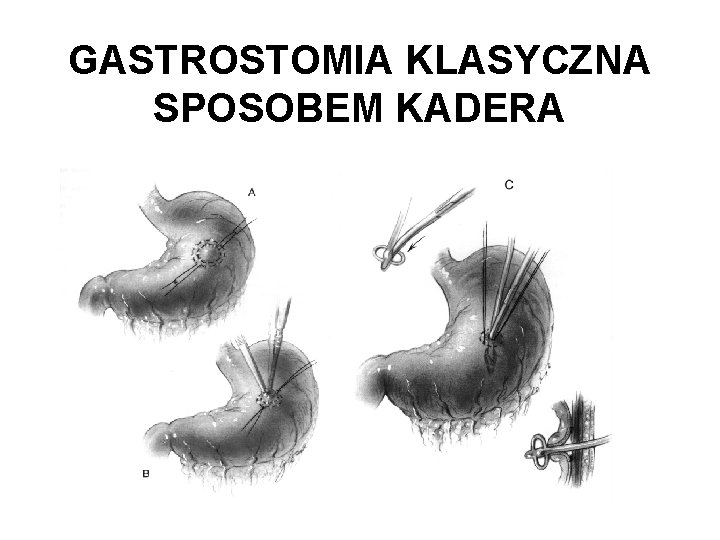 GASTROSTOMIA KLASYCZNA SPOSOBEM KADERA 