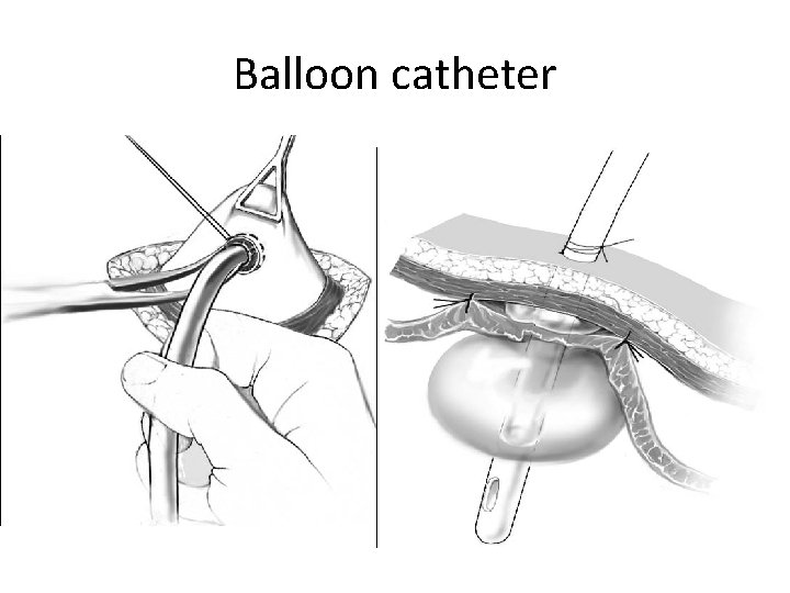 Balloon catheter 